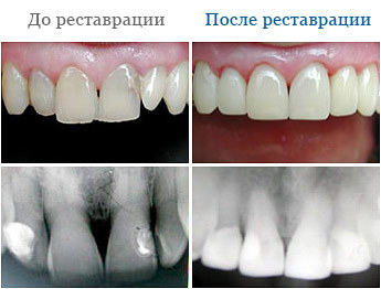 Лечение сколов зубов красноярск