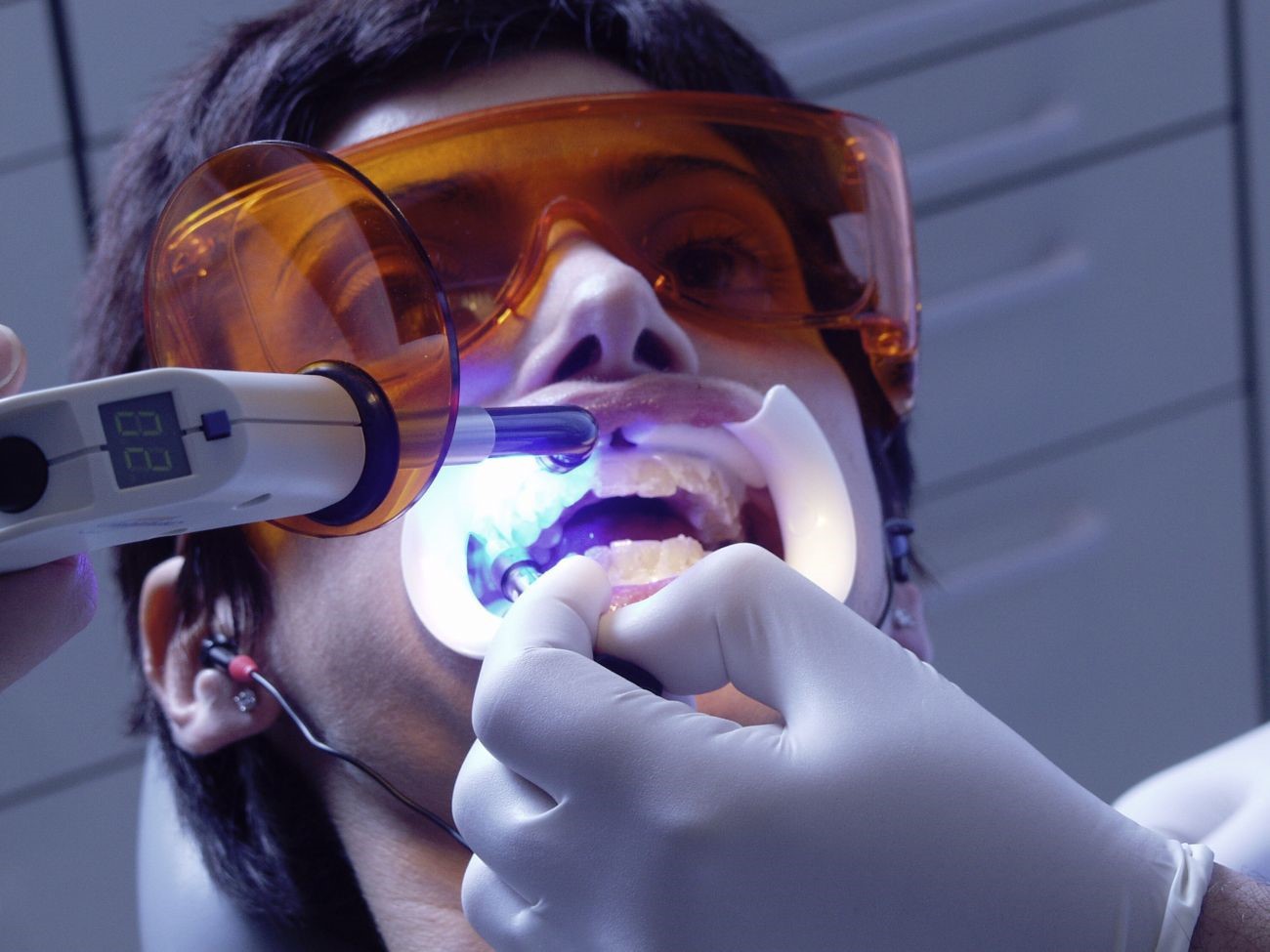 Лазерное отбеливание зубов плюсы и минусы цена лечение ларингита ингалятором