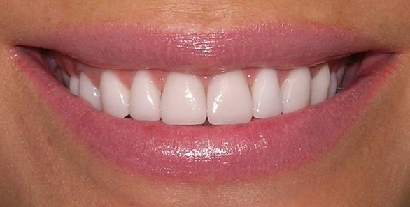 Лечение сколов зубов красноярск